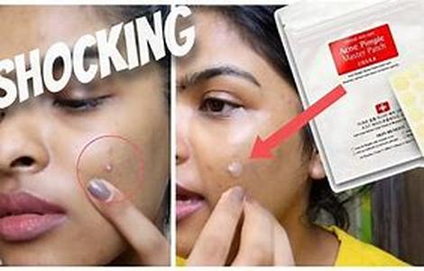 Acne Treatments