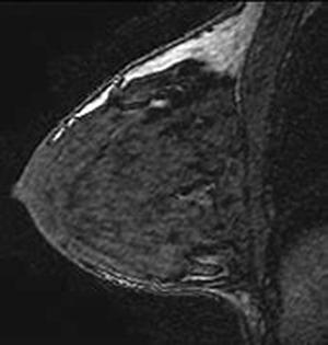 Breast Cancer: What Women Should Know