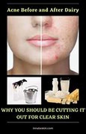 Cystic Acne Remedies