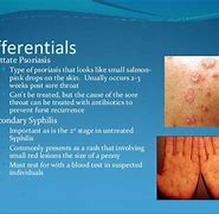 Treating Fibromyalgia Symptoms Naturally