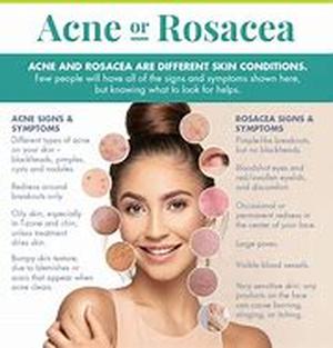 Acne Laser Surgery
