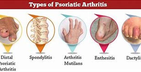 Psoriasis- Relief From Psoriasis