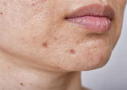 Acne Talk For Teenagers