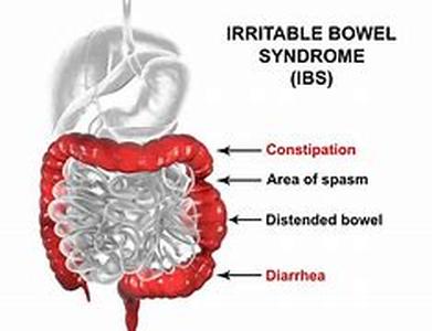 Irritable Bowel Symdrome