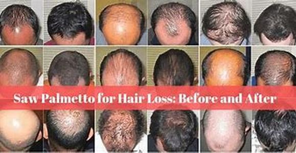 Saw Palmetto For High Blood Pressure
